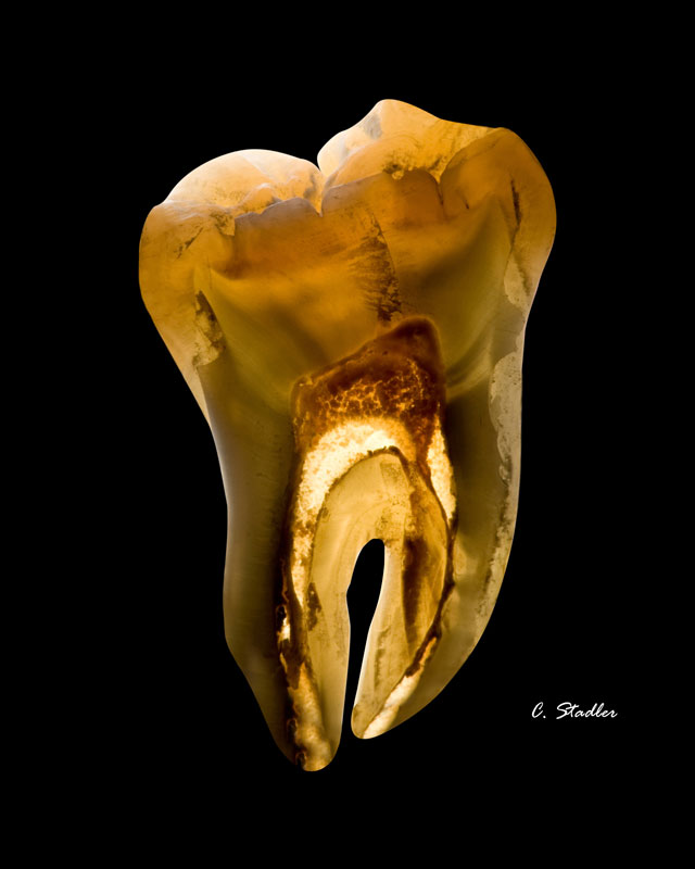 Stadler – Fotografia Artística – Prótese Dentária
